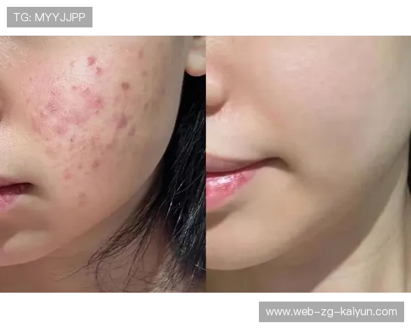 运动与痘痘:为什么运动后长痘,为什么运动完后痘痘变明显了